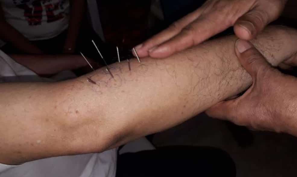 Acupuncture treatment at Acutouch Wellness